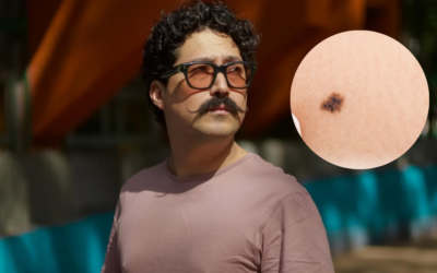 ¿Cómo detectar un lunar que puede ser peligroso como el de Mau Nieto?
