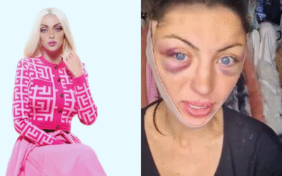 ¿De qué murió la influencer conocida como ‘Barbie Humana’?