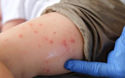 Casos de sarampión en México: los estados con más contagios en 2026