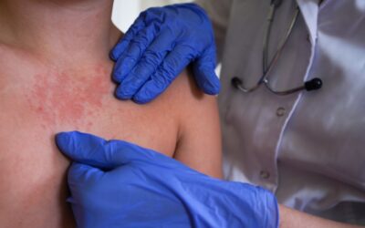 ¿Qué es el sarampión? Síntomas, cómo se contagia y complicaciones de la enfermedad